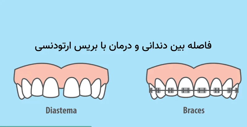 درمان فاصله بین دندانی با بریس ارتودنسی