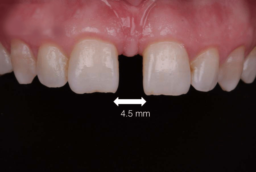 علل فاصله بین دندان ها یا دیاستما