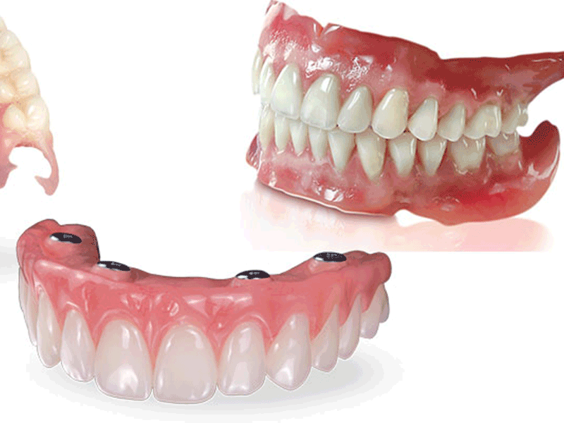 دندان مصنوعی ژله‌ای بهتر است یا معمولی