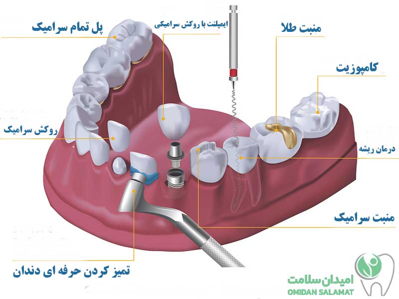 عوامل تاثیرگذار بر قیمت ایمپلنت دندان