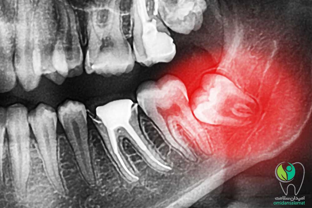 جراحی دندان عقل به چه صورت است؟