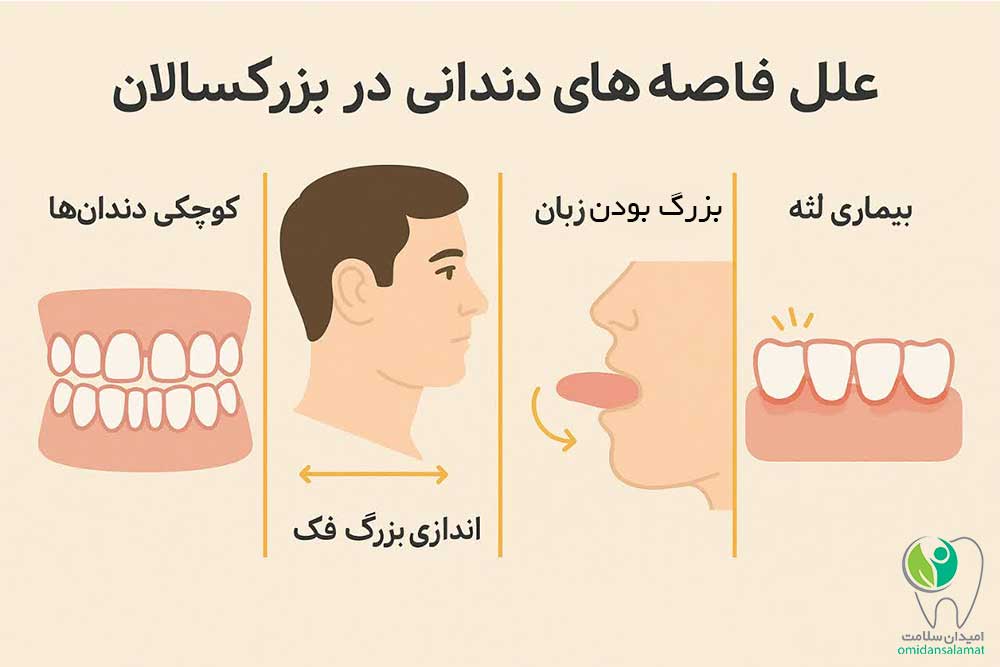 علل فاصله های دندانی در بزرگسالان چیست؟
