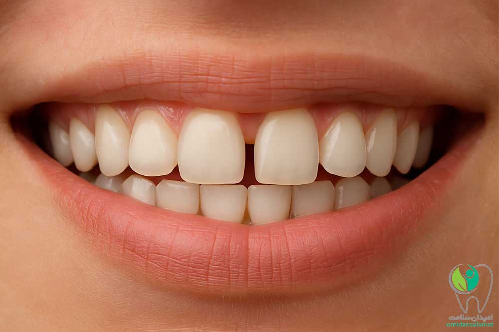 هزینه های بستن فاصله بین دندان ها