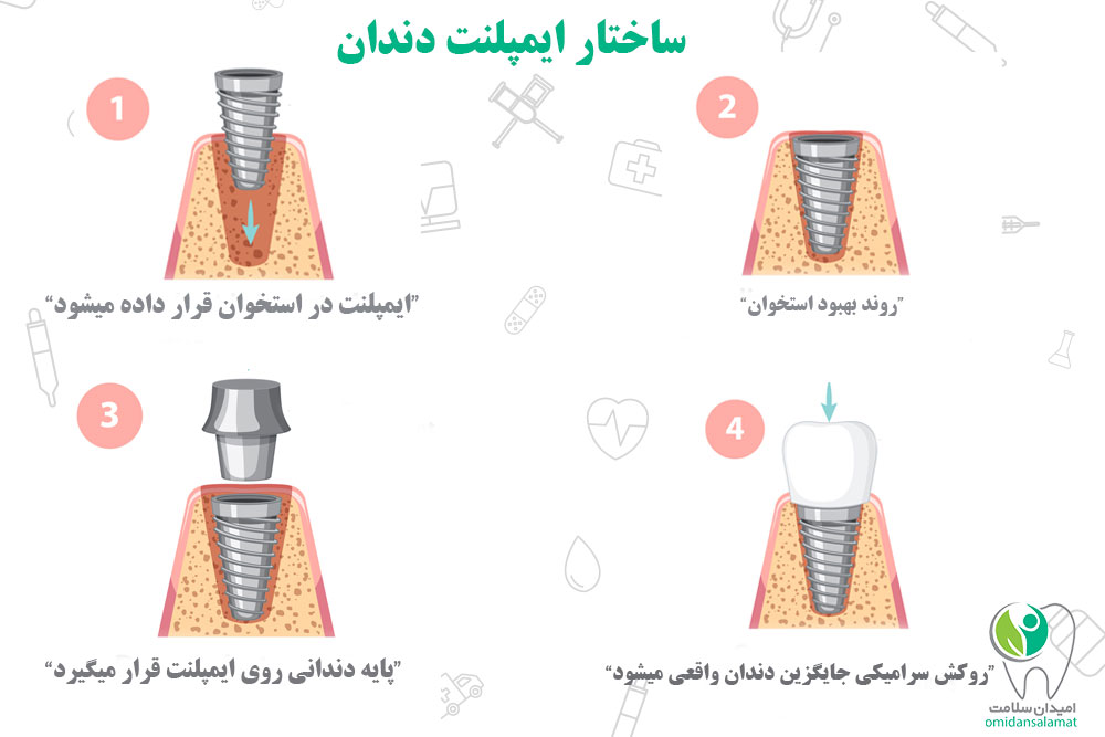 چطور با کارت تخفیف، هزینه ایمپلنت دندان را نصف کنیم؟