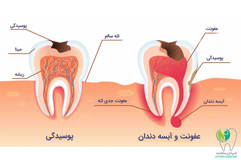 هزینه درمان آبسه و عفونت دندان